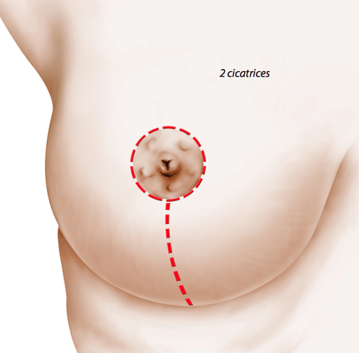 Réduction mammaire Chirurgie esthétique à Montpellier - Dr Ziade Réduction mammaire