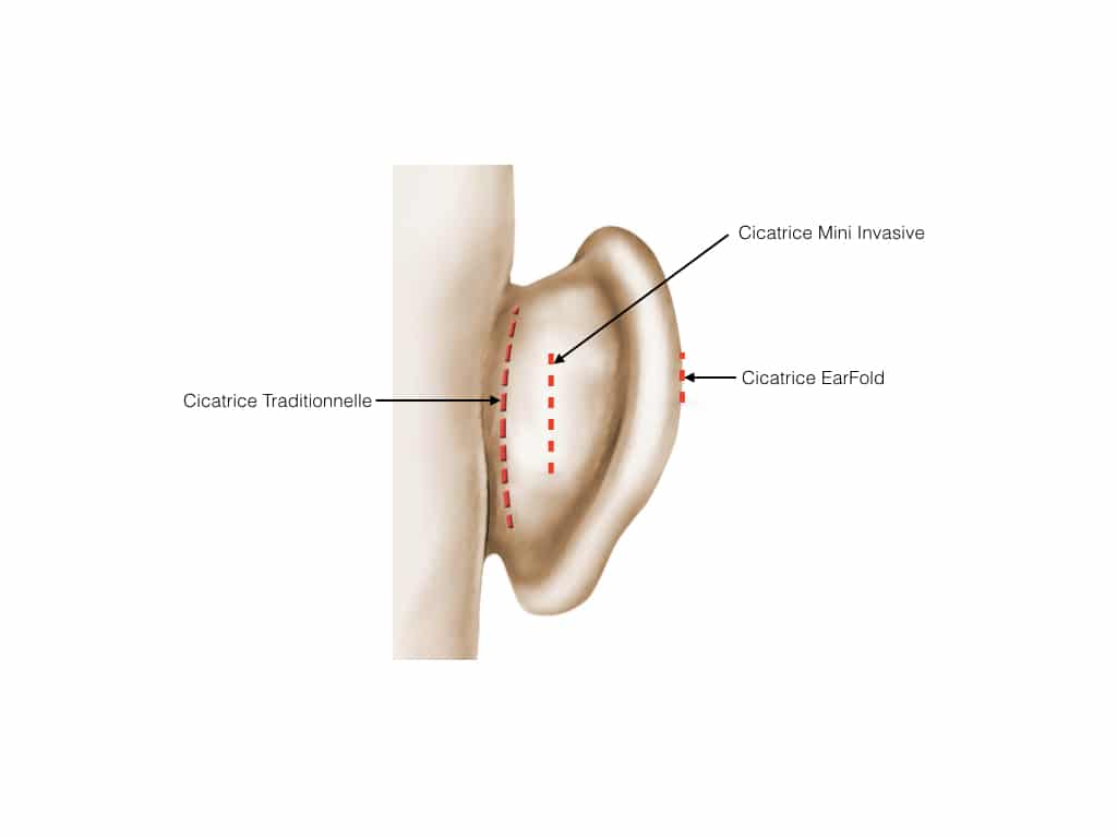 Oreilles décollées Otoplastie Chirurgie plastique - Dr Ziade Oreilles décollées