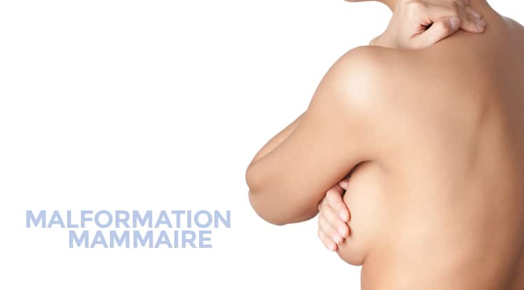 Malformation mammaire Chirurgie des seins à Montpellier - Dr Ziade Chirurgie des seins à Montpellier
