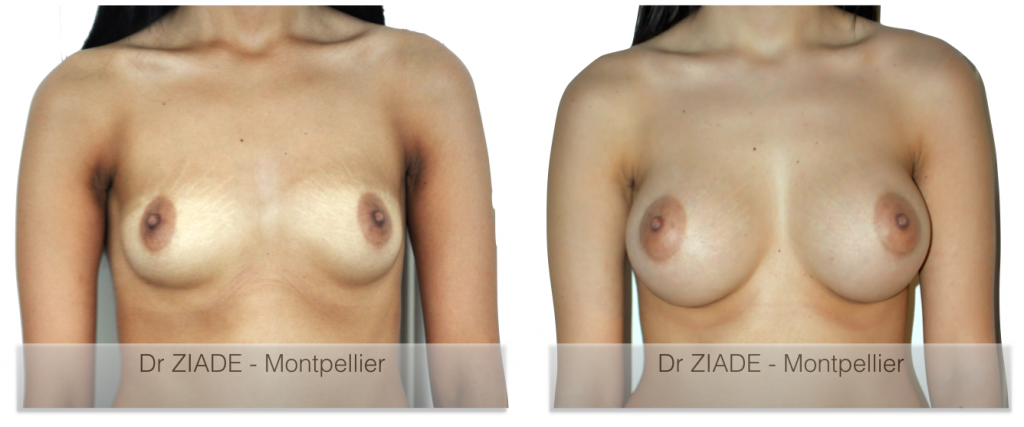 Prothèses mammaires - Dr ZIADE - Chirurgie Esthétique - Montpellier