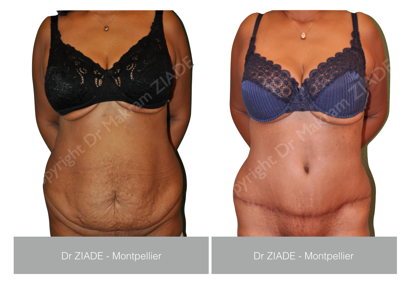 Dr ZIADE - Abdominoplastie Montpellier