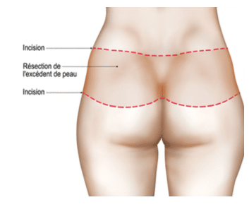 bodylift