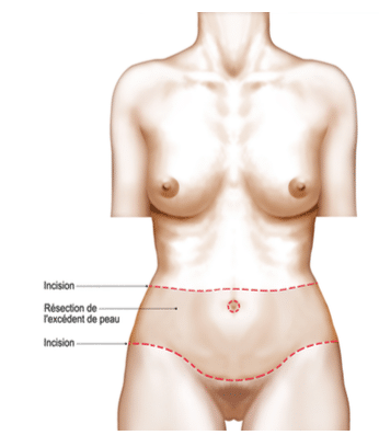 chirurgie esthetique montpellier bodylift