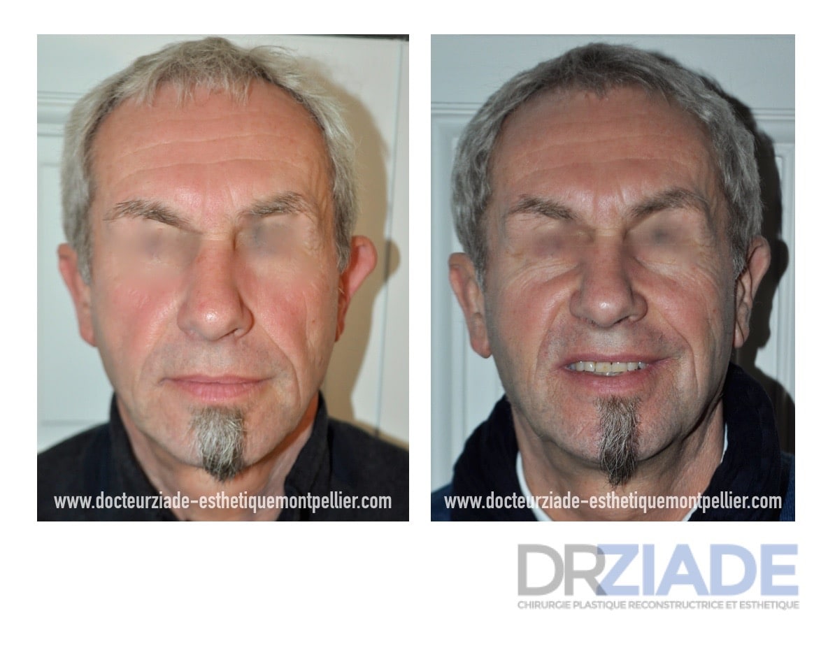 Chirurgie des Oreilles décollées par le Dr Makram ZIADE - Chirurgien esthétique à Montpellier