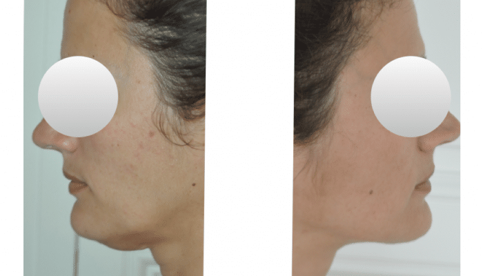 lipoaspiration du menton