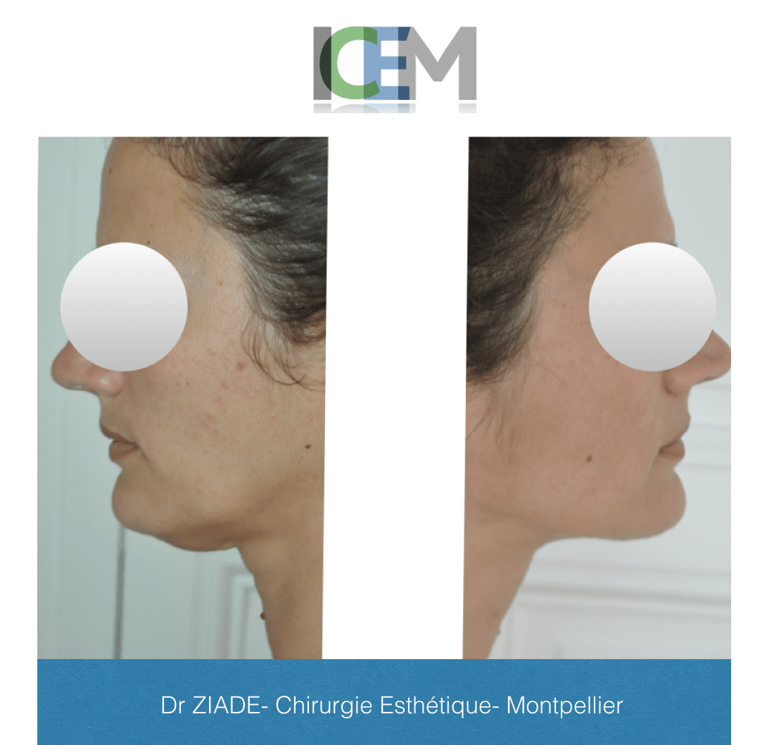 lipoaspiration du menton