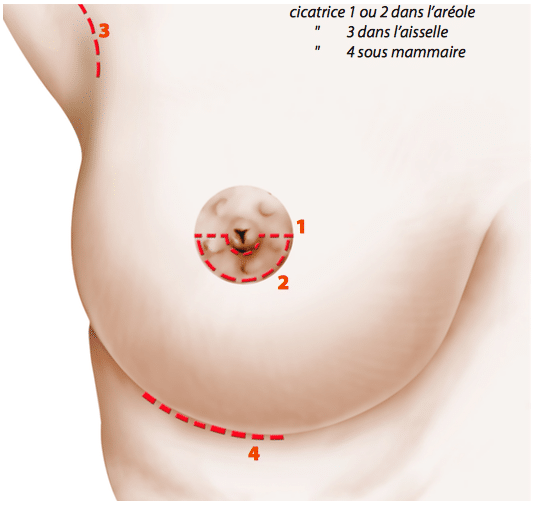 schéma explicatif des possibilités de cicatrices pour chirurgie esthétique d'augmentation mammaire Montpellier - Dr Ziade Augmentation mammaire