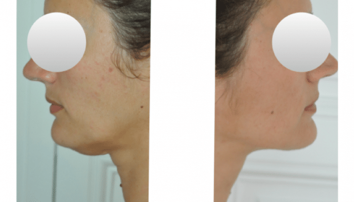 lipoaspiration du menton