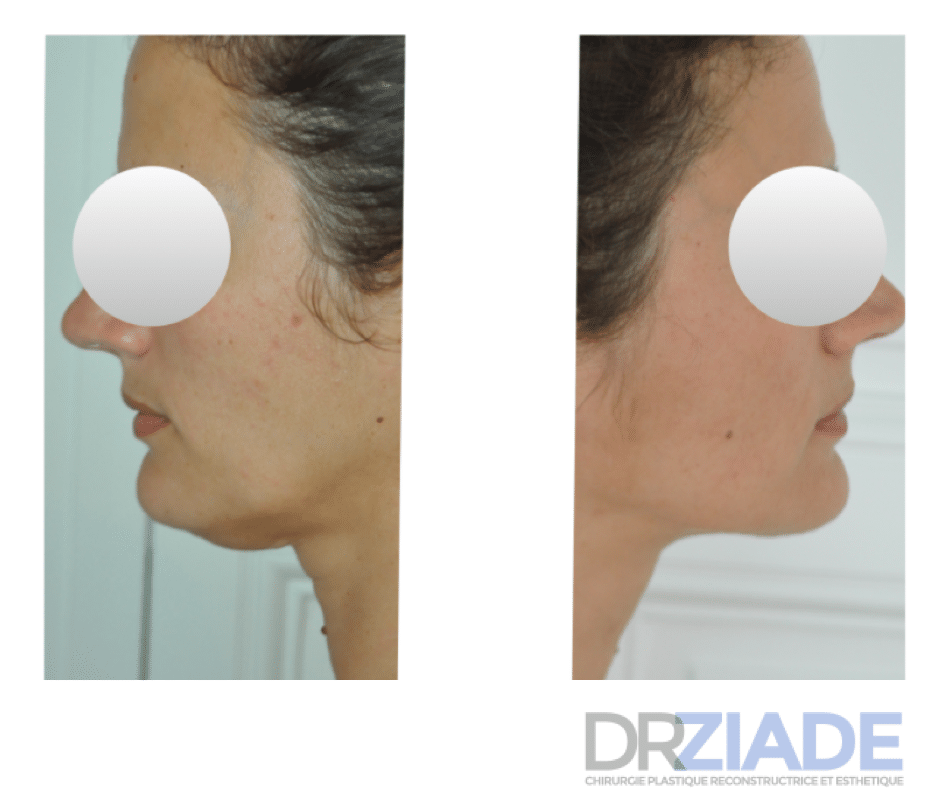 lipoaspiration du menton