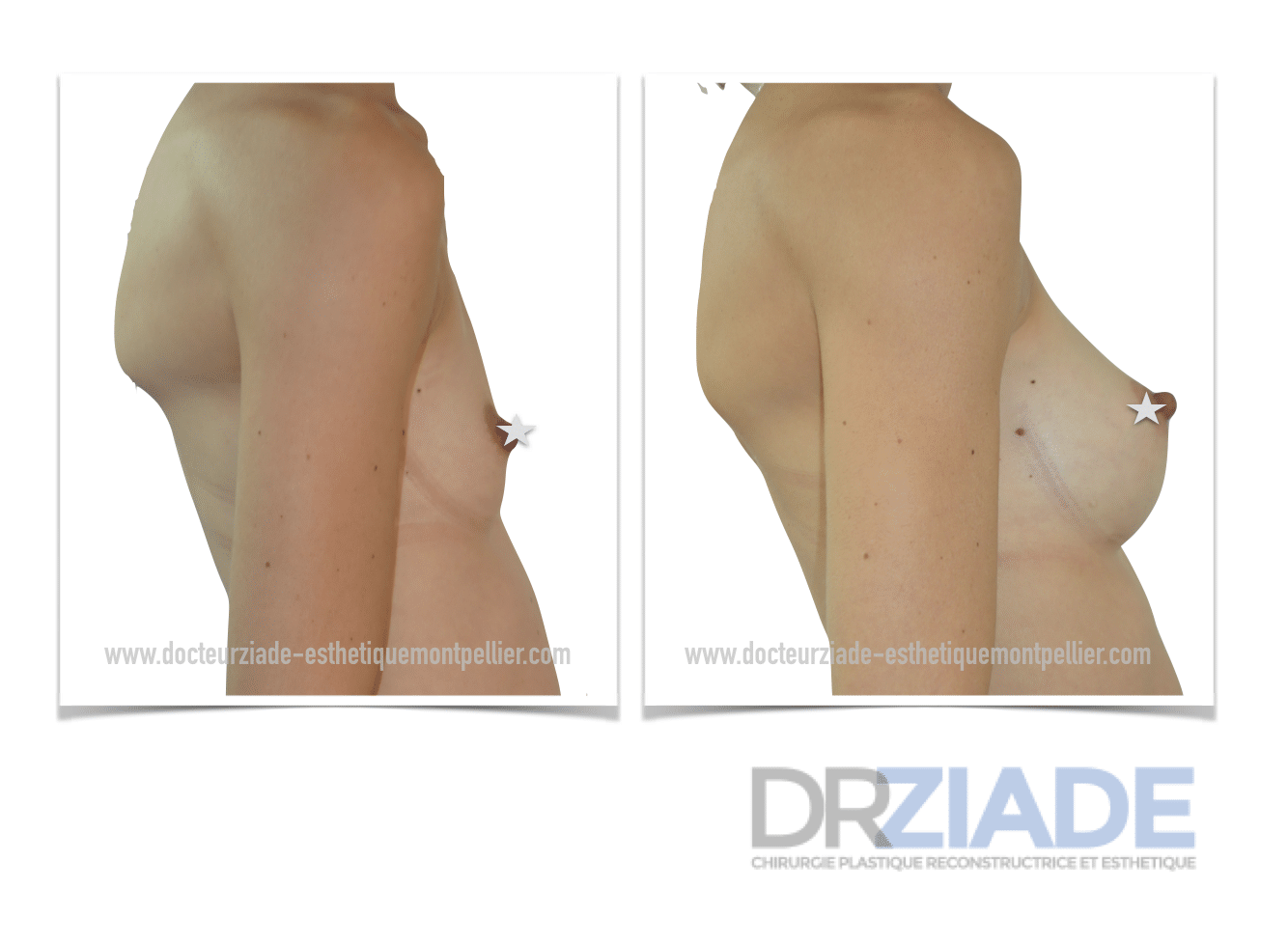 Augmentation mammaire avec un effet naturel Montpellier - Dr ZIADE