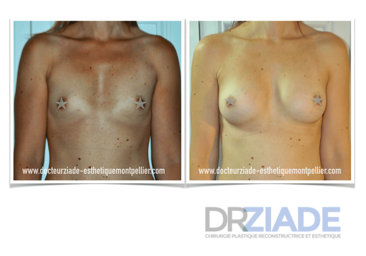 augmentation mammaire par prothèse Dr Ziade