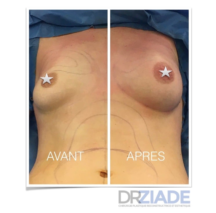 Augmenter le volume de ses seins sans prothèse