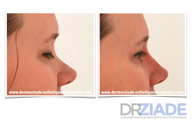 Changer la forme de son nez sans chirurgie - Acide hyaluronique montpellier