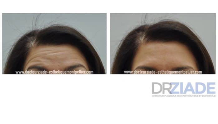 Le botox contre les rides
