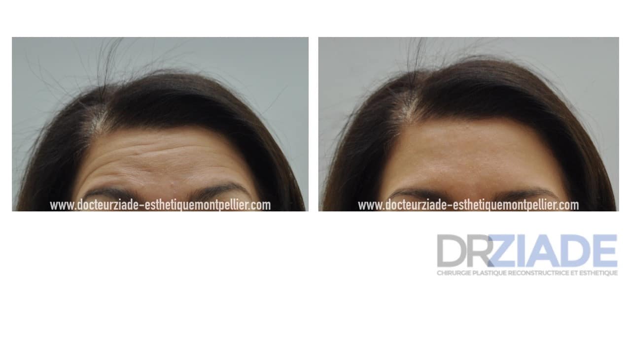 Le botox contre les rides