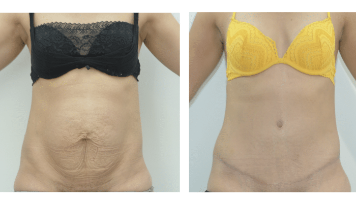 Avant / Après Abdominoplastie