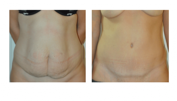Abdominoplastie