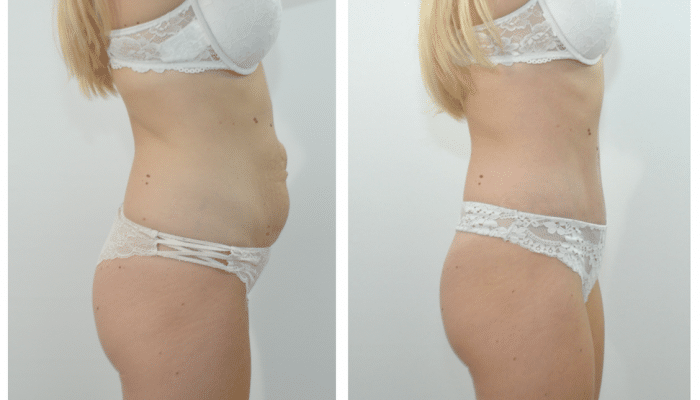 Abdominoplastie