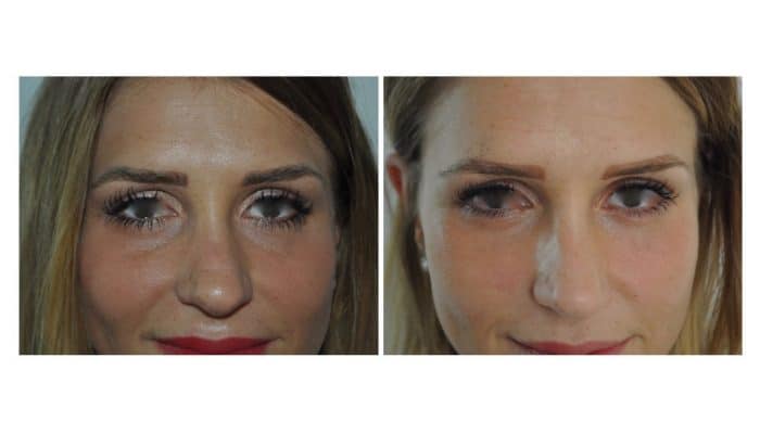 Injection d'acide hyaluronique au niveau des cernes