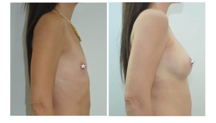 Augmentaion mammaire par le Dr ZIADE Montpellier