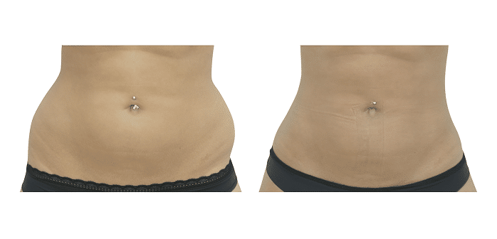 Avant / Après Lipoaspiration