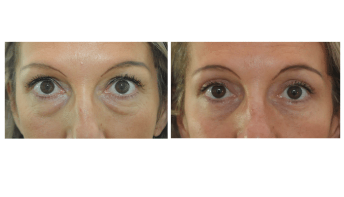 avant/après blépharoplastie des 4 paupières
