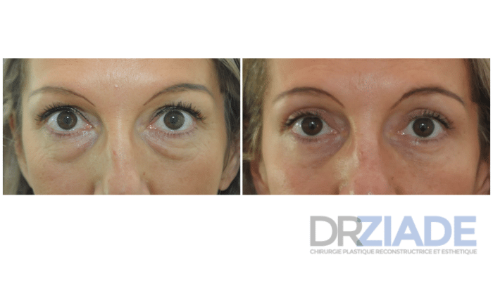 blépharoplastie supérieur et blépharoplastie inferieure
