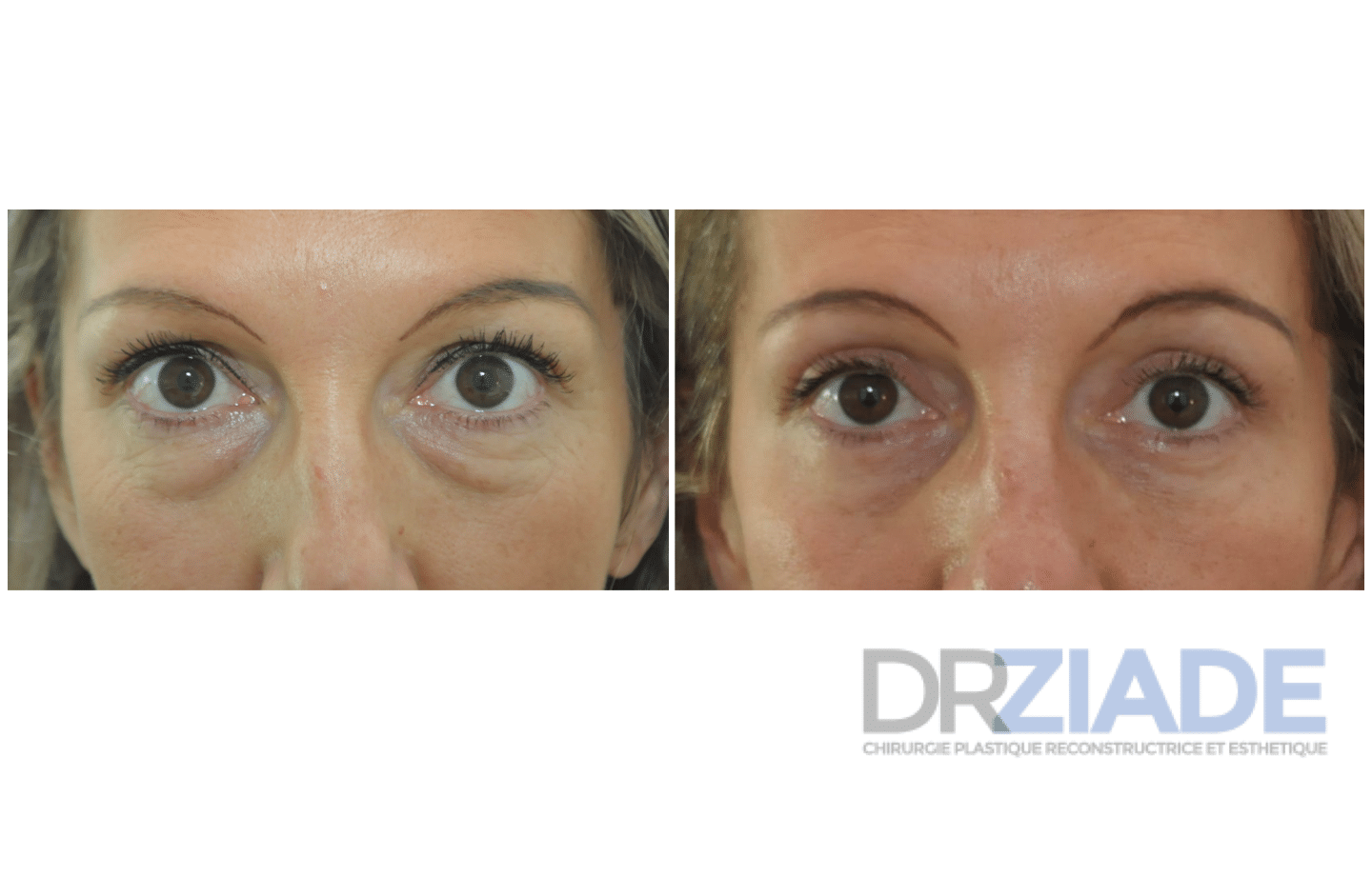 blépharoplastie supérieur et blépharoplastie inferieure