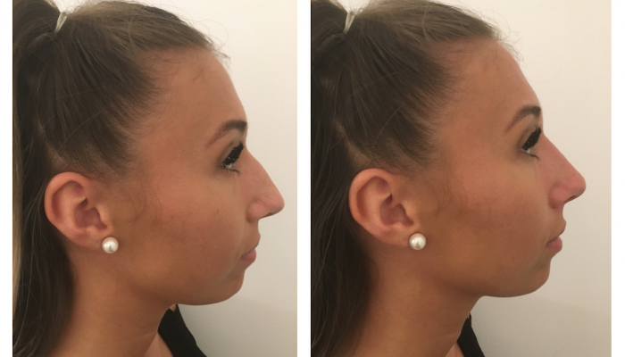 Rhinoplastie médicale