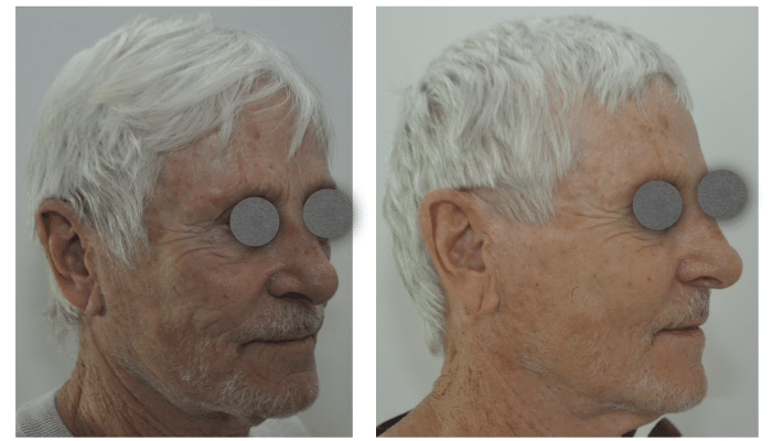 Avant / Après Lifting cervico facial