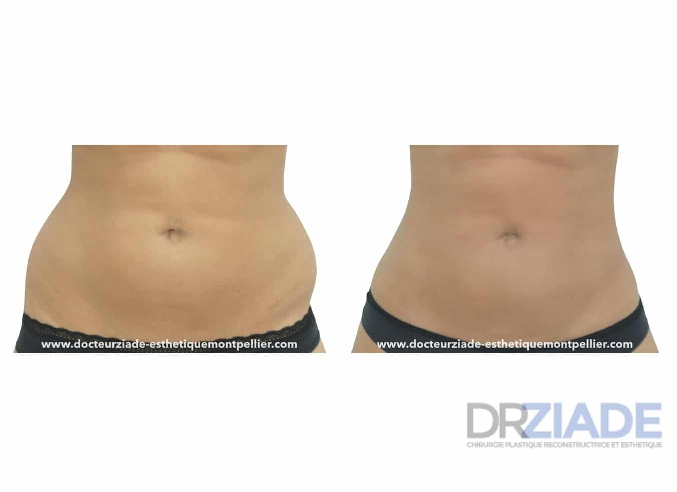 Lipoaspiration des poignées d'amourMontpellier