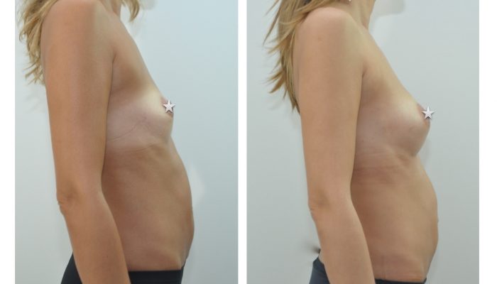 Lipofilling des seins par le Dr ZIADE à Montpellier