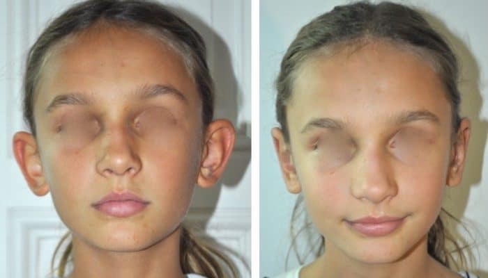 Oreilles décollées par le Dr ZIADE à Montpellier