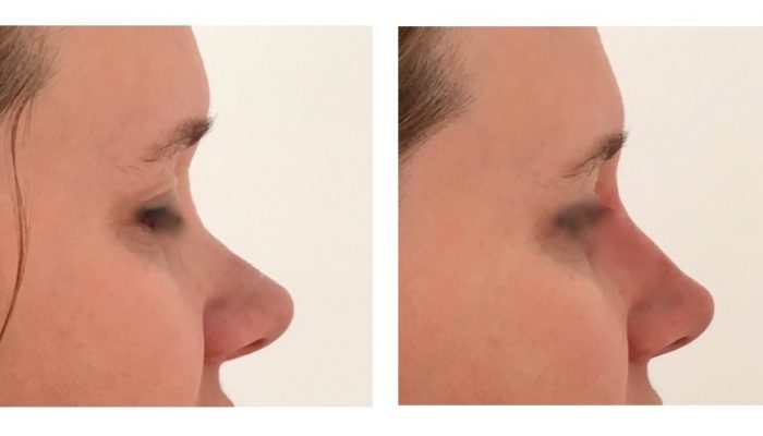 Rhinoplastie médicale par le Dr ZIADE à Montpellier