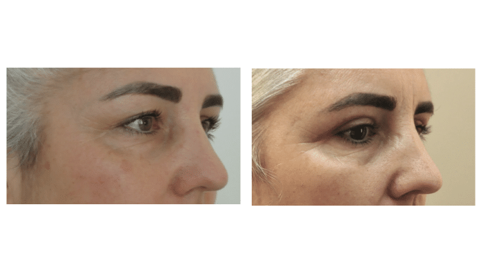Avant / Après blépharoplastie