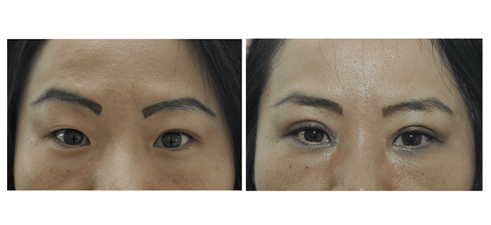 Avant - Après Blépharoplastie