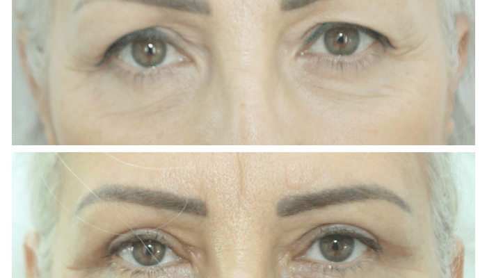 Avant / Après blépharoplastie supérieure
