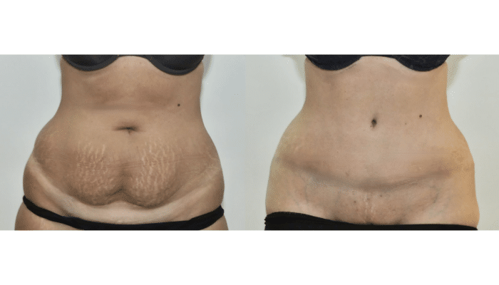 Abdominoplastie