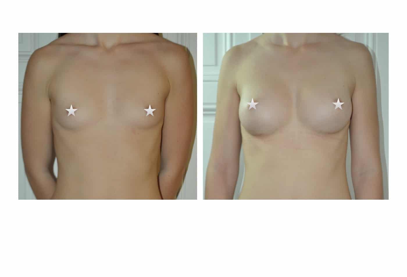 Augmentation mammaire montpellier