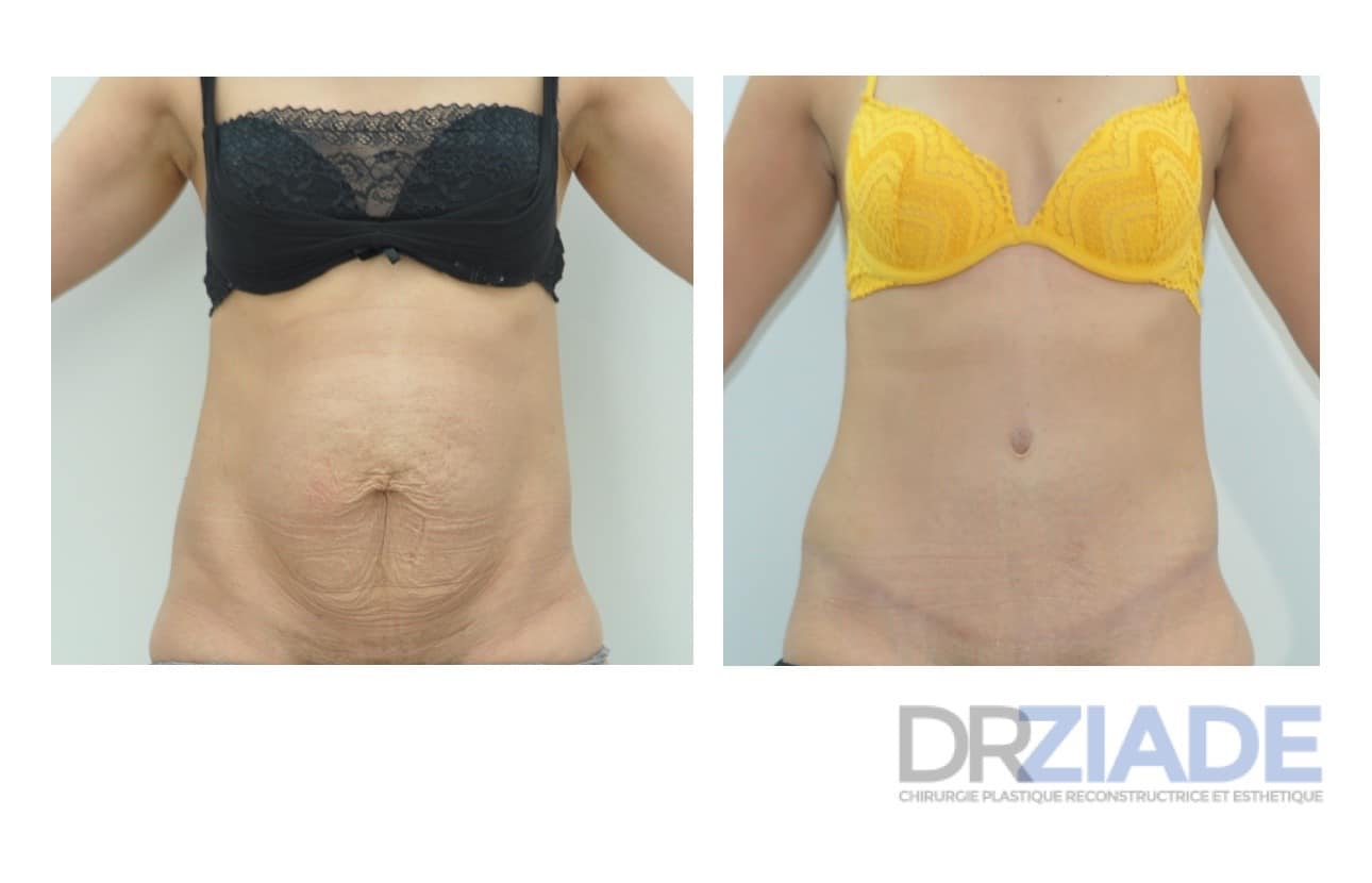 Abdominoplastie Montpellier
