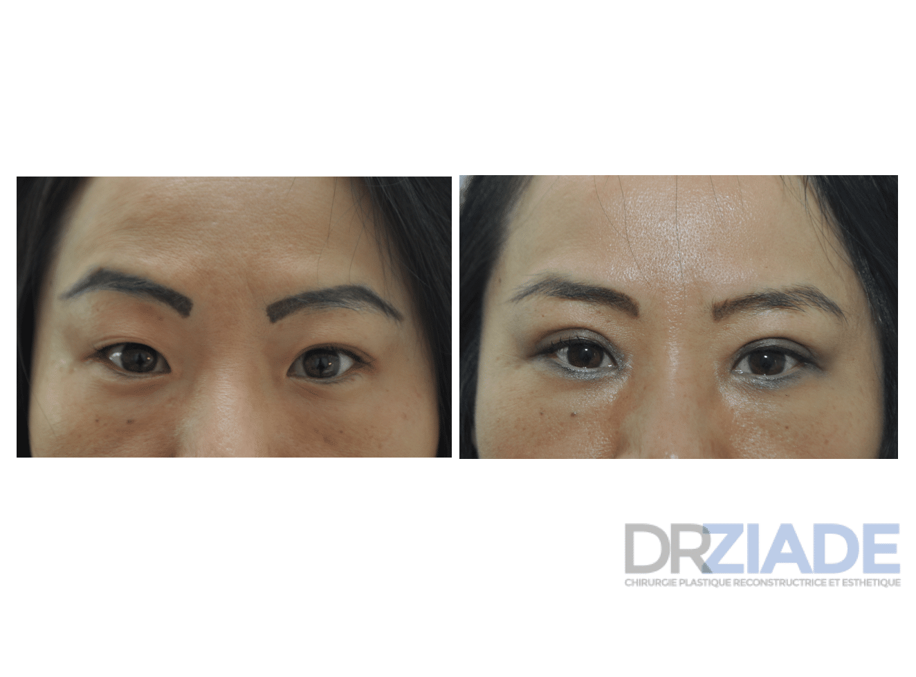 photo avant après d'une blépharoplastie asiatique