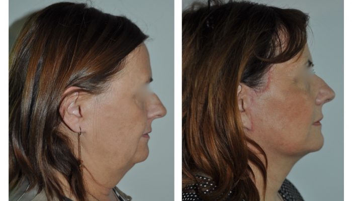 Mini lifting du visage