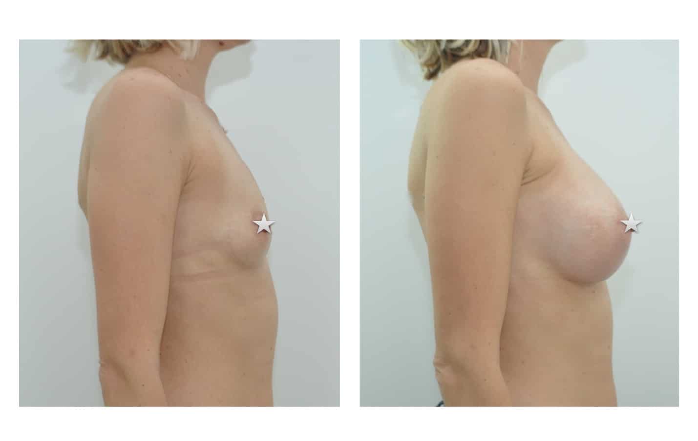 comment choisir son implant mammaire