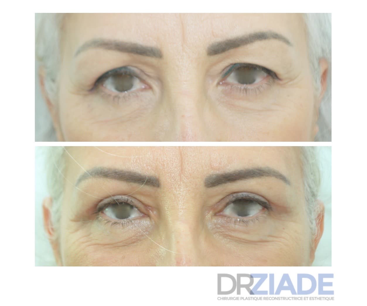 blépharoplastie supérieure
