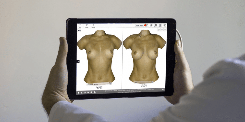 rendu d'une simulation 3 D avant après d'augmentation mammaire