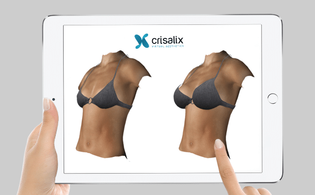 vue d'une augmentation mammaire en 3D par le dr ziade