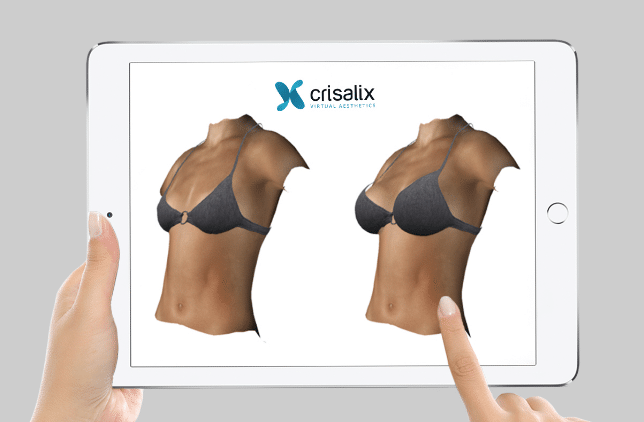 vue d'une augmentation mammaire en 3D par le dr ziade