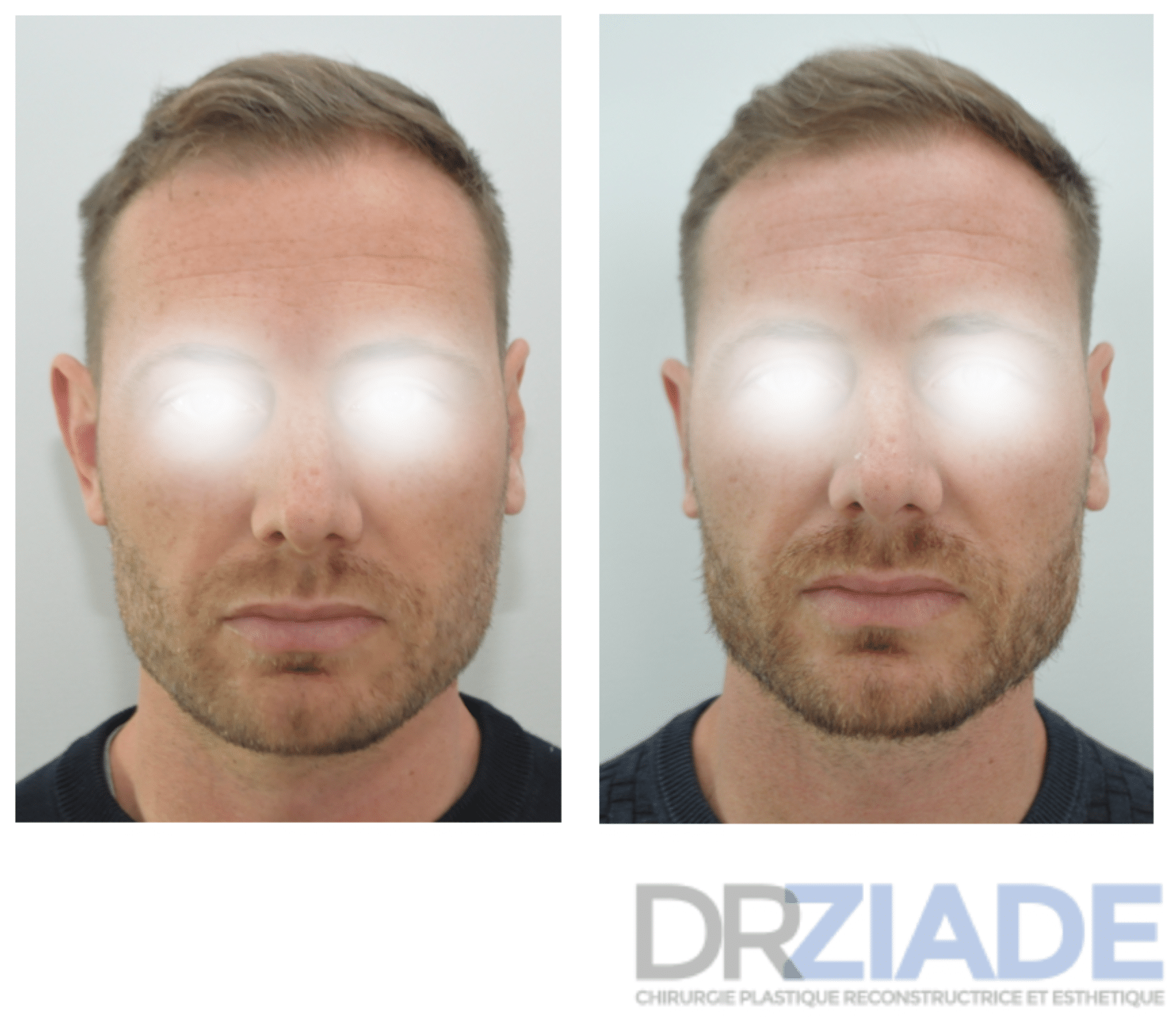 avant/après chirurgie des oreilles