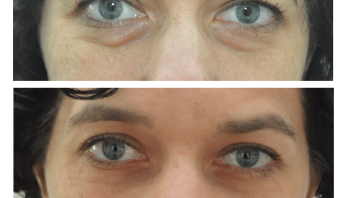 avant/apres blepharoplastie par voie conjonctivale