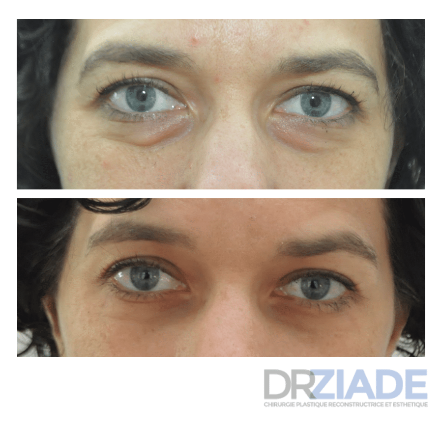 avant/apres blepharoplastie par voie conjonctivale